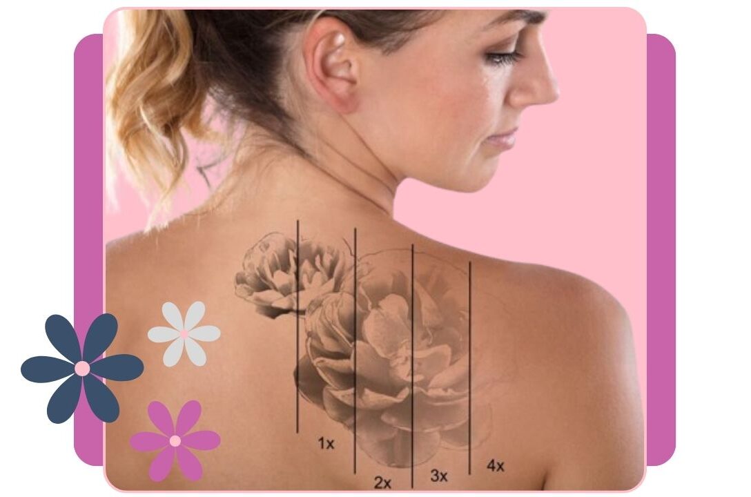 Quitar tatuajes